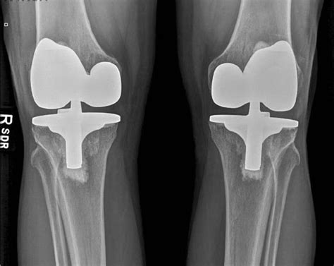 Patient Story Osteoarthritis And Total Knee Replacement Orthoinfo Aaos