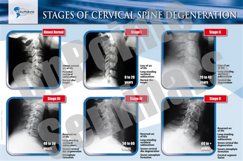 Onpointe Seminars Stages Of Cervical Spine Degeneration