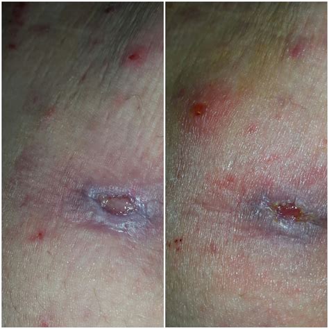 Before your appointment, you might want to write a list that includes: MRSA: Treating it naturally: My journey with MRSA / Cellulitis