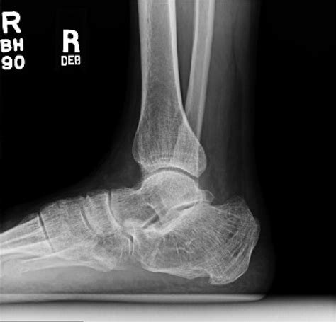 Subtalar Arthrodesis For Post Traumatic Subtalar Arthritis Journal Of
