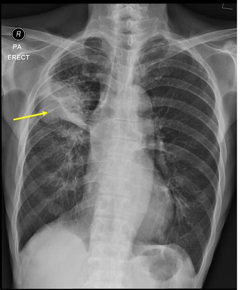 Collection 92 Pictures Lung Cancer X Rays Photos Excellent