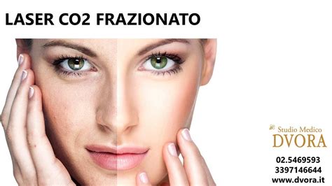LASER CO2 FRAZIONATO MACCHIE DEL VISO - DVORA ANCONA - YouTube