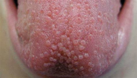 How To Get Rid Of Bumps On Tongue Lordunit28