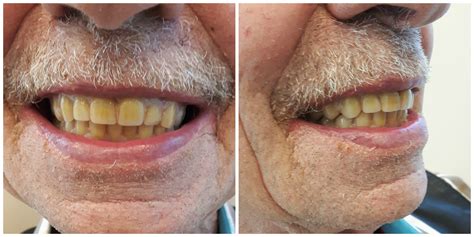 Precision Complete Upper And Lower Dentures In 3 Weeks Kelowna