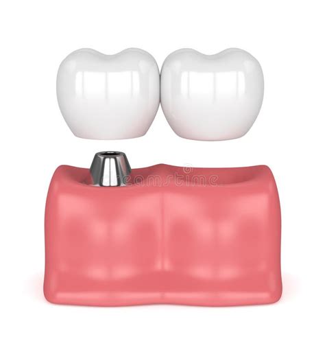 3d Render Of Implant With Dental Cantilever Bridge Stock Illustration