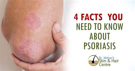 4 facts you need to know about psoriasis