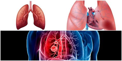 Tromboembolia Pulmonar TEP Síntomas Causas Diagnóstico Formación