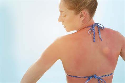 What should i do if i have fiberglass in my skin? Family Magazine: How Long Does Sunburn Itch Last