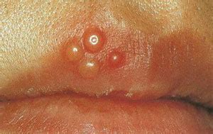 アートメイクTips：口唇ヘルペスについて | 東京都港区のアート ...