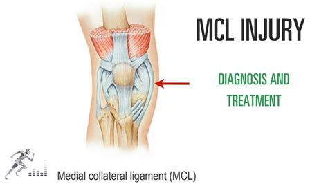 Mcl Tear Of The Knee Injury Diagnosis Treatment Youtube