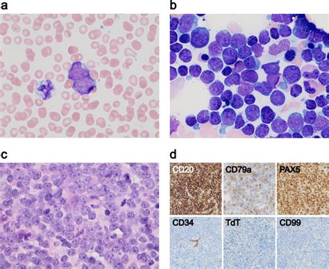 A Peripheral Blood Smear At Presentation Showed Circulating Neoplastic