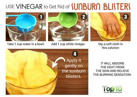 How To Get Rid Of Sunburn Blisters Top 10 Home Remedies