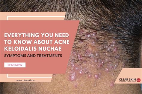 Everything You Need To Know About Acne Keloidalis Nuchae Symptoms And Treatments