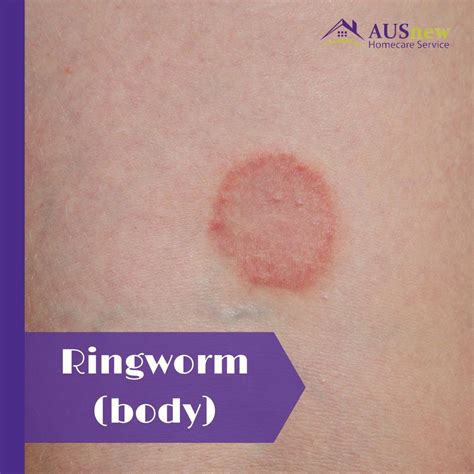 Ringworm Body How To Treat This Skin Infection Ringworm Body Symptoms