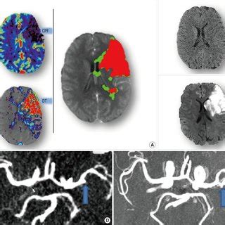 Marc w parsons, wallace parsons, marc parson. Acute CTP images of Case 4. It shows a region in right MCA ...