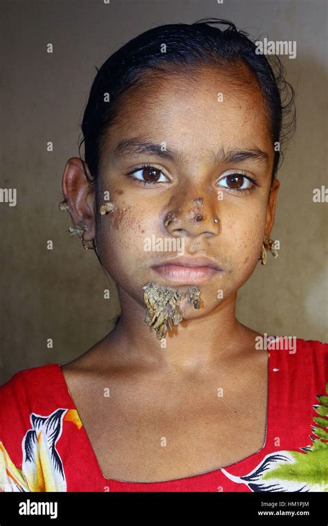 Dhaka Bangladesh févr Patient du Bangladesh Sahana Khatun pose pour une photo