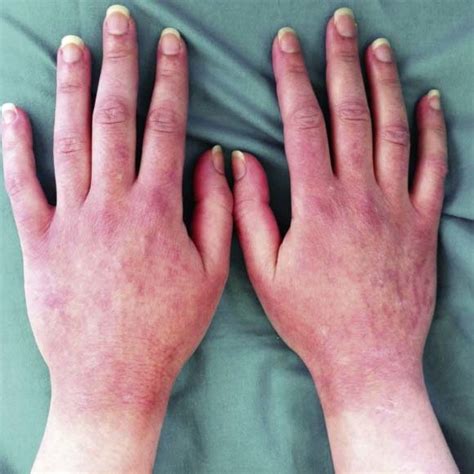 Erythematous Desquamative Lesions Presented By The Patient When She