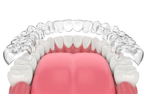 Burbank Dentist Explains How Invisalign Offers Better Smiles