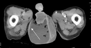 Fournier gangrene (fg) is a type of wet gangrene. Early signs of Fournier gangrene: Radiological characteristics