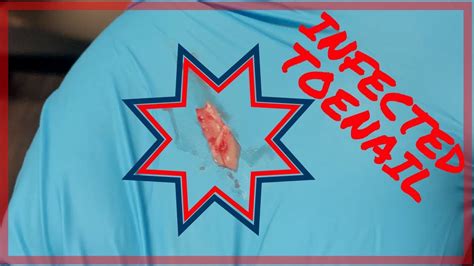 When infected, they can become abscesses or boils. Deep infected ingrown nail removal! | Adam Siegel, DPM ...