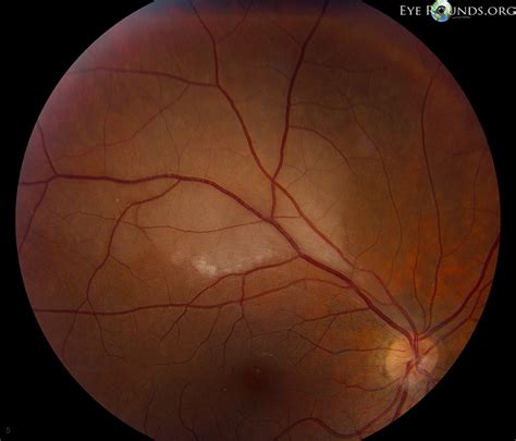 Atlas Entry Branch Retinal Artery Occlusion Brao