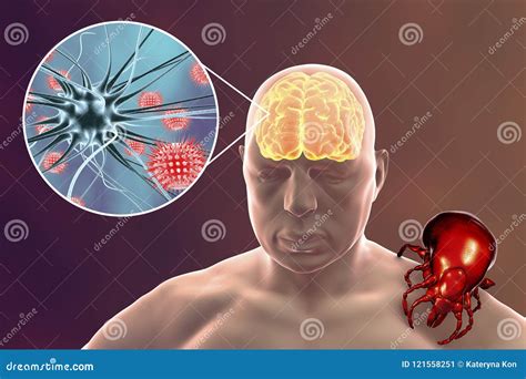 Encephalitis Concept Illustration Showing Edema And Hemorrhages In