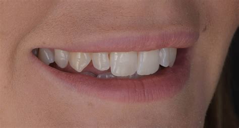 Veneers For Peg Laterals Are Veneers Right For Peg Teeth