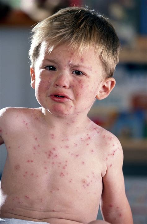 Rashes And Stomach Aches In Kids