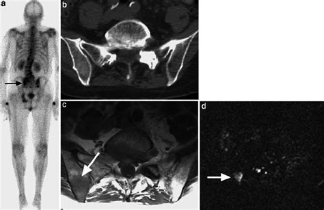 Diffusion Weighted Imaging Of Blastic Bone Metastasis From Prostate