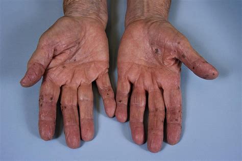 Lichen Planus On The Hands Medlineplus Medical Encyclopedia Image My