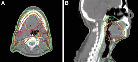 Adverse Radiation Therapy Effects In The Treatment Of Head And Neck