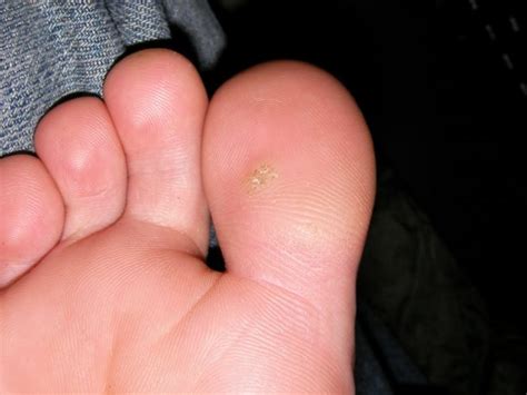 Warts On Feet Podiatrist Foot Care Liberty Township Ohio
