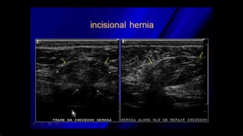 Ultrasound Of Hernias Pandora Screenshot Ultrasound Desktop Screenshot