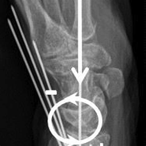 Lateral Wrist Radiograph Rotation Around The Y Axis Is Supination À