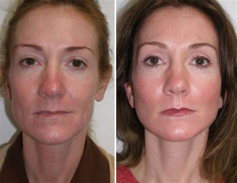 The other type of plastic surgery is called 'cosmetic'. Weekend Facelift Gallery Richmond VA | Cosmetic Facial Surgery