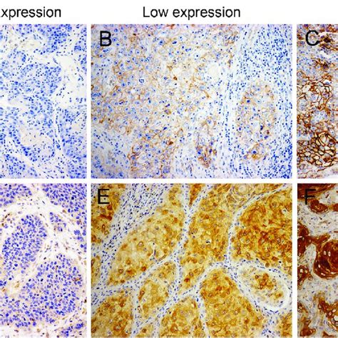 Immunohistochemical Staining Of The Representative Cases For Pd L1