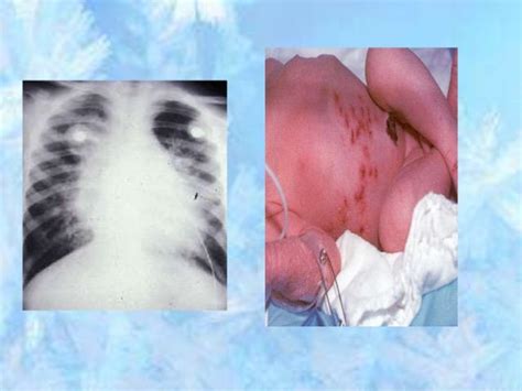 Neonatal Herpes Simplex Infections