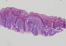 Acantomi epidermolitici anogenitali: trattamento efficace ...