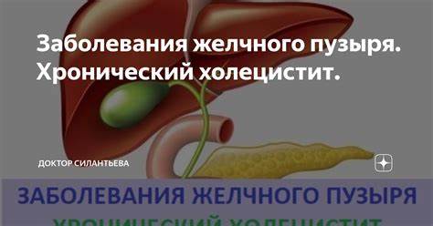 Острый холецистит диеты Заболевания желчного пузыря. Хронический холецистит. | Доктор Заболевания желчного пузыря. Хронический холецистит. | Доктор Острый холецистит диеты