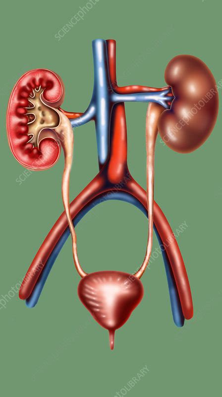 Nephritis Stock Image F0316968 Science Photo Library
