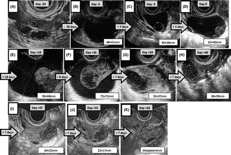 Ovarian Cyst And Cancer Ultrasound