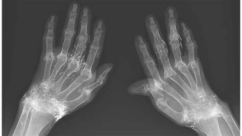X Rays Show Gold Splinters Embedded In Womans Hands Iflscience