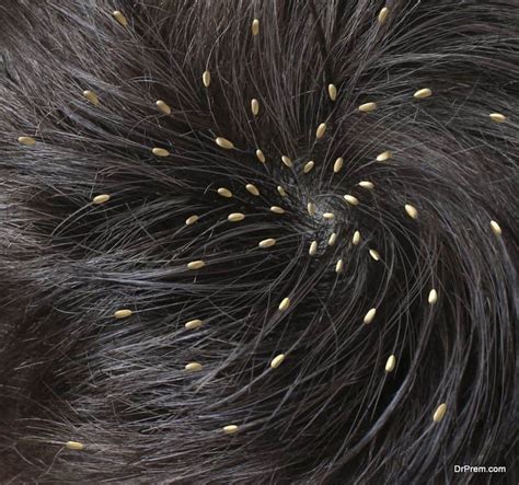 Close Up Of Someones Head Infested With Head Lice Global Healthcare