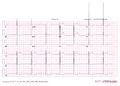 For the first two thirds of the cohort, ecgs were analyzed manually, whereas after exclusion of all of the patients presenting lvh by the sokolov criteria, 569 patients were left for. Chamber Hypertrophy and Enlargment - ECGpedia