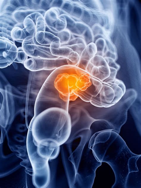 It extracts water and salt from. Retinoic acid suppresses colorectal cancer development ...
