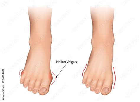 Illustration Of The Normal Foot And Hallux Valgus Human Foot Deformity