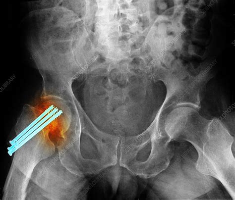 Repaired Hip Fracture Stock Image C0094789 Science Photo Library