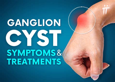 Ganglion Cyst Symptoms And Treatment Methods Turan Turan