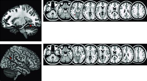 11:25 grzegorz kurzejamski 134 просмотра. Fig. S2. (Upper) Whole brain searchlight analysis in NT ...
