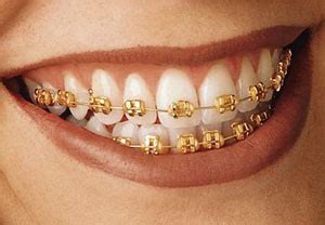 Since they do have a yellow or white gold color, gold crowns are used primarily to restore molars and premolars. Styles of Braces | Dr. Ron Kolodziej